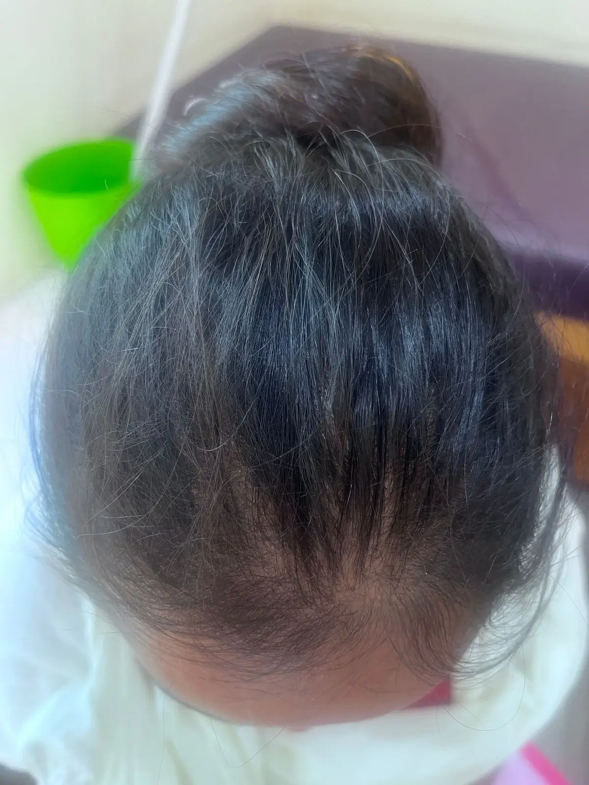 Female Pattern Baldness case 5 after treatment